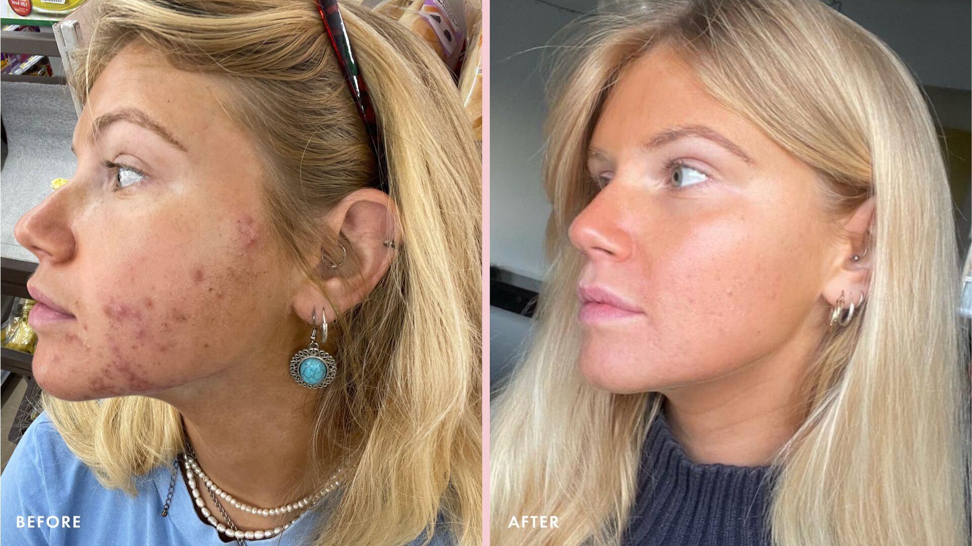 Millie Godfrey's before and after from acne